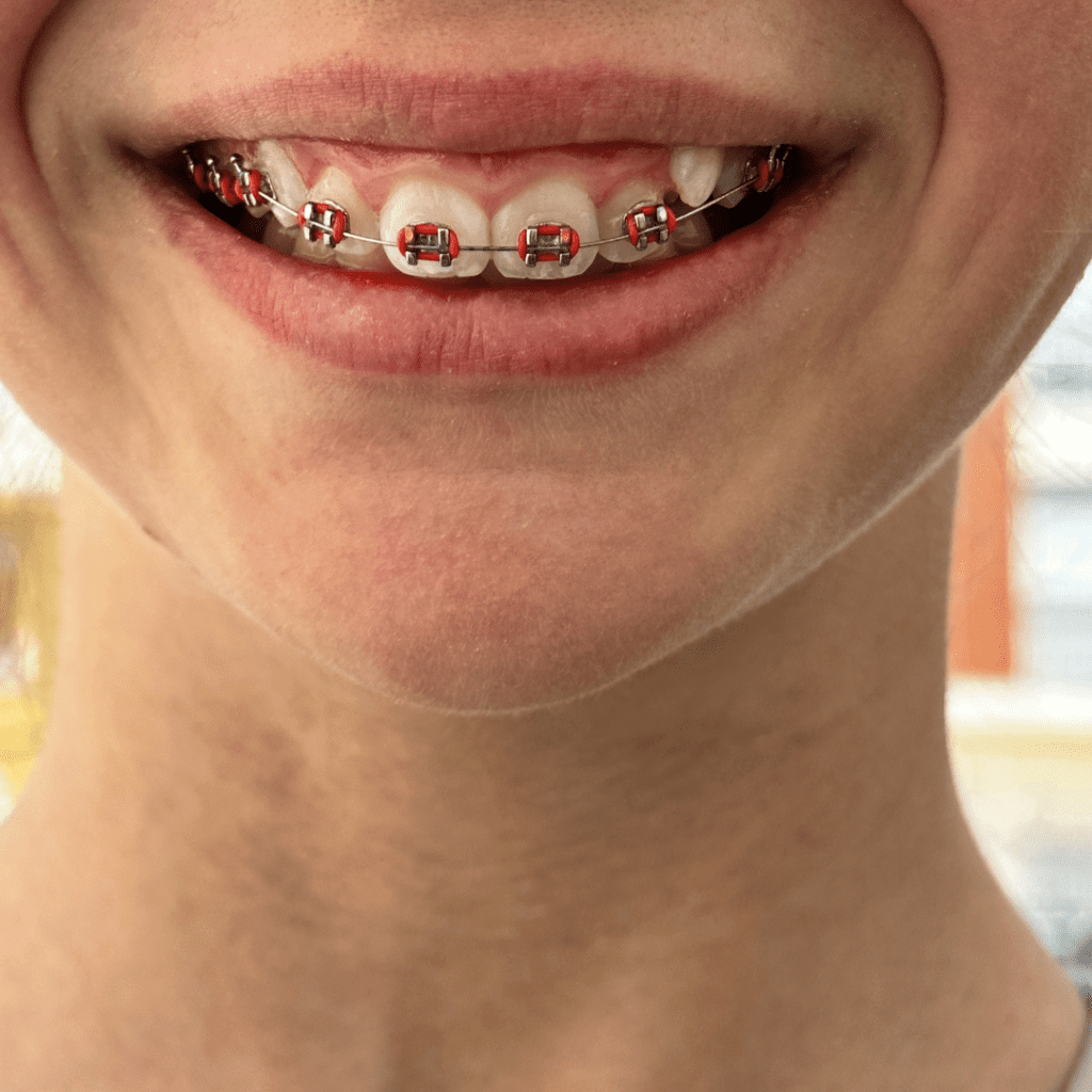 kids silver teeth